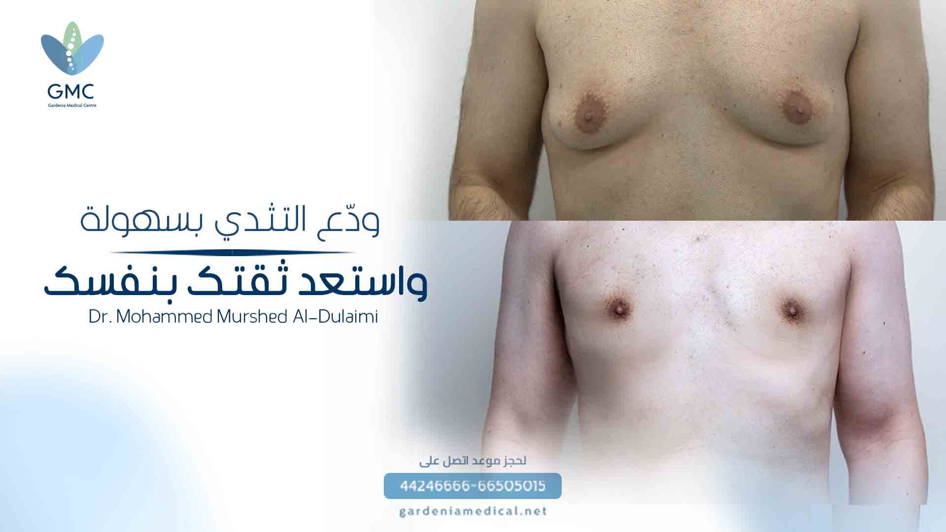 علاج التثدي عند الرجال: استعد ثقتك ومظهرك الرجولي