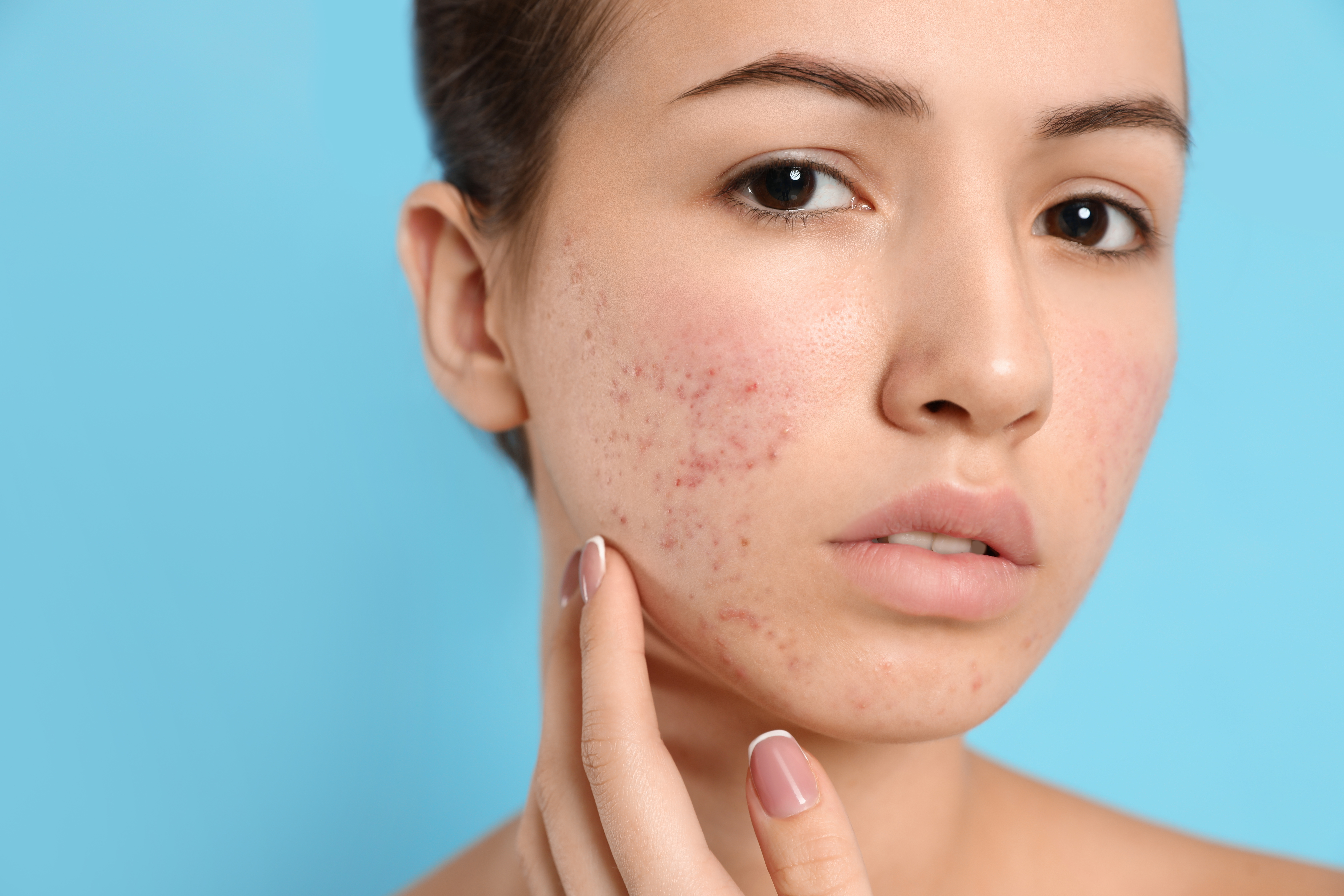 How We Treat Acne Scars & Pigmentation in Doha