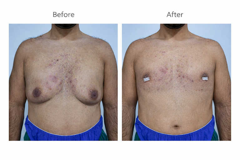 أفضل دكتور لعلاج التثدي في قطر: د. محمد مرشد الدليمي