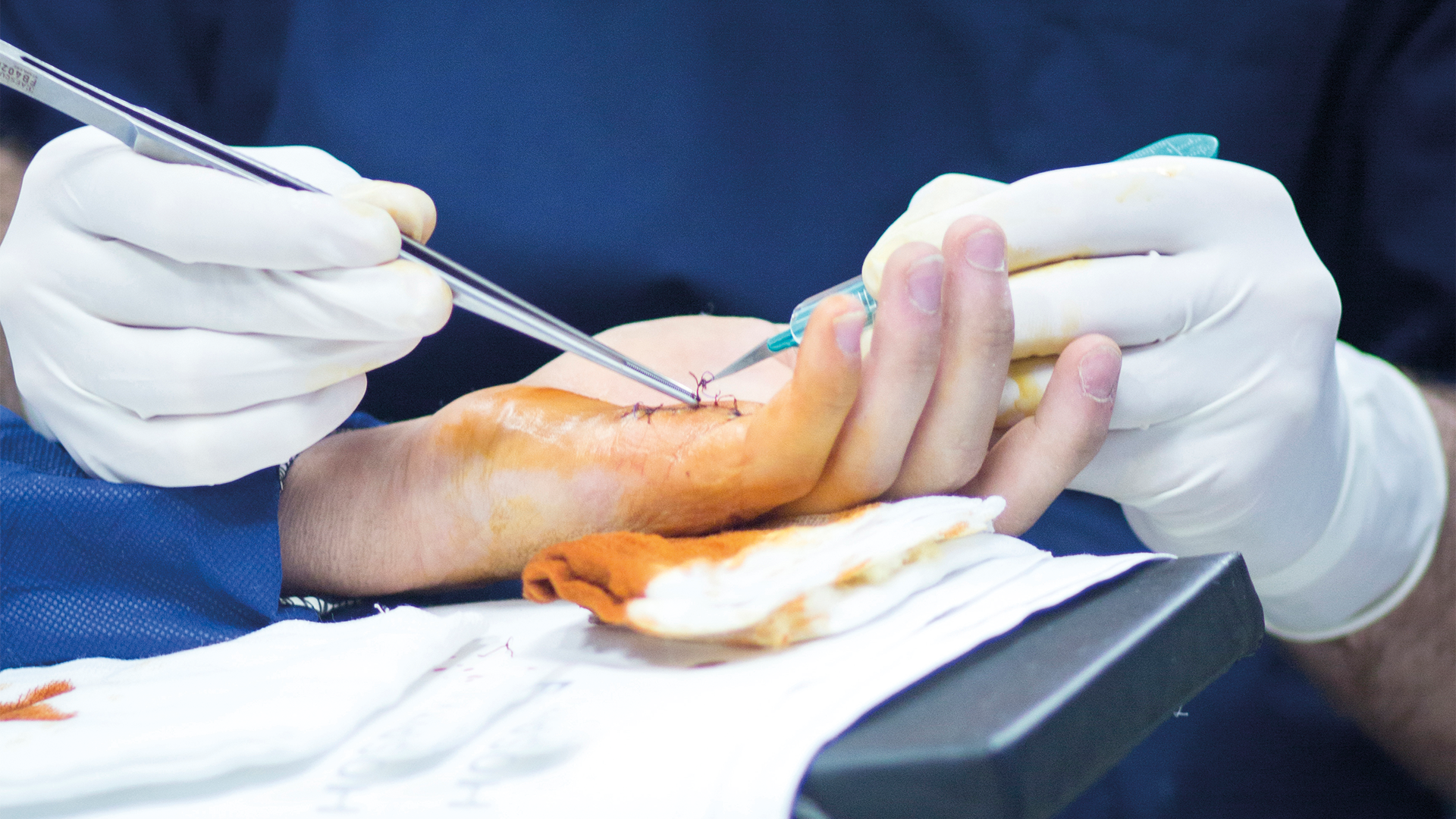Hand Surgery